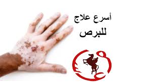 علاج البرص ما هو علاج البرص طبيعي عيون الرومانسية