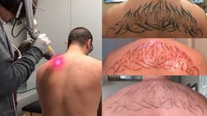 Laser Tattoo Removal The Ugly Truth Youtube