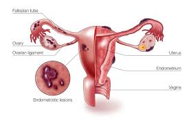 Some ovarian cysts may need removal with an operation. Endometriosis Punca Simptom Dan Cara Rawatan The Diagnosa