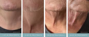 Image result for Radiation Dermatitis