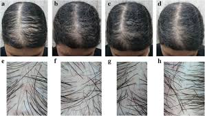 Great savings & free delivery / collection on many items. Trichogenic Effect Of Topical Ketoconazole Versus Minoxidil 2 In Female Pattern Hair Loss A Clinical And Trichoscopic Evaluation Biomedical Dermatology Full Text
