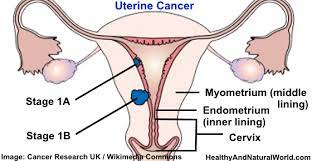 Cancer can make you need to go more often, you have difficulty in removing urine or in pain when you do. Uterine Endometrial Cancer Symptoms Risk Factors And Prevention