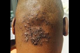 The role testosterone and dht have on hair loss. Derm Dx A Papular Rash On The Scalp Clinical Advisor