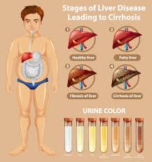 Diagram of body liver reach the liver via the portal circulation and then enter the systemic circulation to distribute into various tissues in the body only un ionized drug can passively diffuse across cell. Stages Of Liver Disease Educational Diagram 1337978 Vector Art At Vecteezy