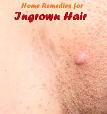 Anyone can get an ingrown hair. 11 Remedies For Get Rid Of Ingrown Hair Ideas Ingrown Hair Ingrown Hair Remedies Hair Remedies