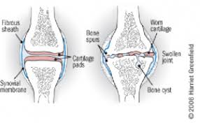 Low impact exercises for knee arthritis. Knee Osteoarthritis Physiopedia