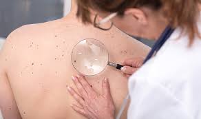 Image result for Merkel Cell Carcinoma