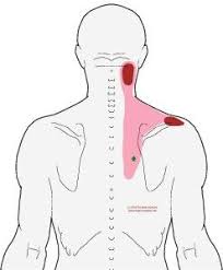 Please tell what is this this a just muscles pain ,stress or kind or paralysis??? Pin On Myofascial Release For Shoulders