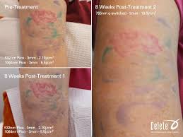 Searching for tattoo removal calgary? The Valley S Best Tattoo Removal With The Exclusive Picoway Laser Call 855 2delete To Receive A Compli Tattoo Removal Cost Diy Tattoo Permanent Tattoo Removal