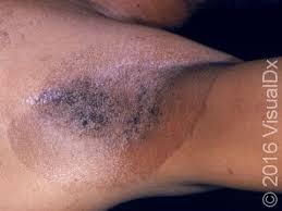 Image result for Erythrasma