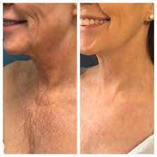 Co2 Laser Resurfacing In Colorado