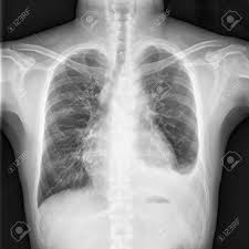 The effusion, in this case, is restricted to one or more fixed pockets within the pleural space. Chest X Ray Shows Cardiomegaly Enlarged Heart With Infiltration Stock Photo Picture And Royalty Free Image Image 81339182