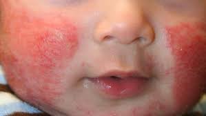 Image result for red rash face