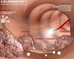 They may not recognize you or may seem upset and out of sorts for no apparent reason. Treating Colon Cancer In The Elderly