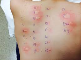 You may have to go on an elimination diet if your doctor thinks you might have a food allergy. Why You Should Consider Food Allergy Testing