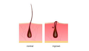 Many people who have thick or curly hair get a type of ingrown hair called pseudofolliculitis. Dark Marks And Scars From Ingrown Hair And Irritation In Pubic Region Skin Hair Problems Medical Answers Body Health Conditions Center Steadyhealth Com