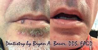 It can occur in any areas of the skin with common occurrences in the areas of the trunk and the. Venous Lake Treatment Hemangioma Laser Treatment Bauer Smiles