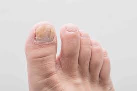Wash your feet and toes with warm, soapy water and a mild soap. An Overview Of Common Toenail Problems