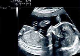 Kurangnya asupan nutrisi dan oksigen bisa akibatnya, bayi kekurangan asupan dan berisiko meninggal dalam kandungan. Tanda Janin Bergerak Ini Usia Kehamilan Si Kecil Mulai Bergerak Semua Halaman Nakita