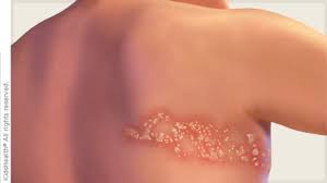 Image result for herpes zoster