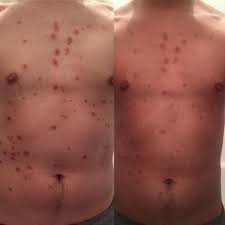 My Psoriasis Just One Week After Beginning Uvb Light Treatment So Excited To Continue And See More Of This Amazing Progress It Can Be Done Psoriasis