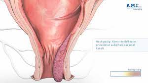 Auch schmerzen und gerüche können symptom bei hämorrhoiden sein. Hamorrhoiden Symptome Schmerzen Analer Juckreiz Co Minimed At