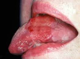 Image result for white cancer on tongue)