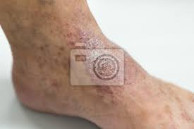 Erste anzeichen für ein atopisches ekzem oder neurodermitis zeigen sich bei neugeborenen bereits in den ersten monaten. Die Atopische Dermatitis Ad Auch Bekannt Als Atopisches Ekzem Fototapete Fototapeten Psoriasis Ekzem Medicals Myloview De