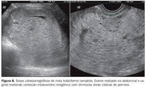Radiologia Brasileira Anormalidades Do Primeiro Trimestre Da Gravidez Ensaio Iconografico