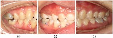 Image result for Tooth Discoloration