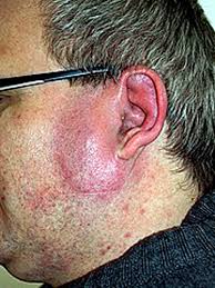 Image result for erysipel photos)