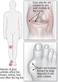 Image result for gout
