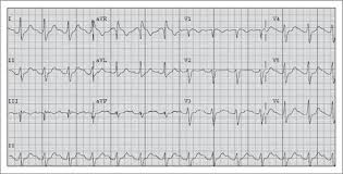 Image result for Flecainide