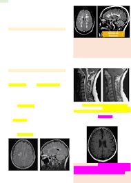 Grátis: Esclerose Multipla e Sd Guillain-Barré - Material Claro e Objetivo  em PDF para Estudo Rápido