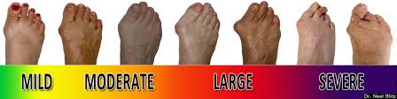 Chronicpain Bunions Podiatry Bunion Foot Problem How To Cure Gout