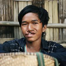 When Ray was born with a cleft, it sent shockwaves through his family. No  one was sure what to do… They did not have access to care. So, for years,  getting treatment