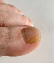 Image result for onychomycosis
