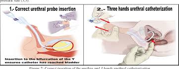 Image result for Urethral Catheterization