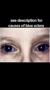 Image result for melanosis sclera
