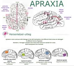 Image result for Apraxia