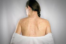 Image result for Varicella zoster on human skin
