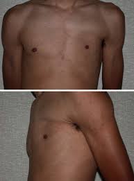It is characterized by having an underdeveloped or absent chest muscle on one side of. Surgical Correction Of Poland S Syndrome In Males A Purposely Designed Implant Journal Of Plastic Reconstructive Aesthetic Surgery