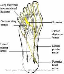 Morton's neuroma of the foot is a common problem that results in swelling and inflammation of the nerves. Mortons Neuroma Orthopaedicsone Articles Orthopaedicsone