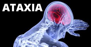 Image result for Ataxia