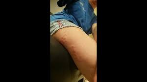 To treat bed bugs austin tx customers must understand that bed bugs austin will stay hidden during day light and will typically only come out of safe the postponement will allow for the population to grow, making the issue harder to resolve for the austin pest control company you contact in the future. Insidious Kissing Bugs Bite Texas Woman She Awaits Chagas Disease Test Results Krem Com