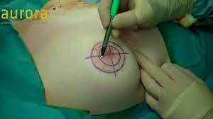 Areola Reduction And Nipple Reconstruction Surgery Youtube