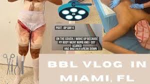 At mia aesthetics, we give our patients many different payment options . Best Of Bbl Before And After Dr Miami Free Watch Download Todaypk