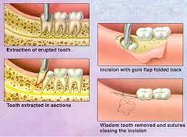 Wisdom Tooth Removal Wisdom Teeth Extraction Singapore