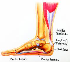 Heel Spur Syndrome | Foot & Ankle Doctors, Inc.