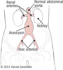 Abdominal Aortic Aneurysms Triple A Double Trouble